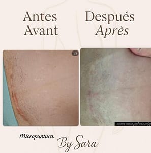 micropuntura