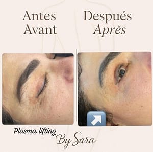plasma lifting